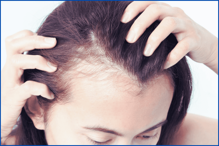 Symptoms of Female Alopecia