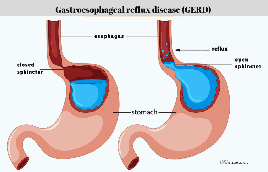 Acid Reflux (GERD)