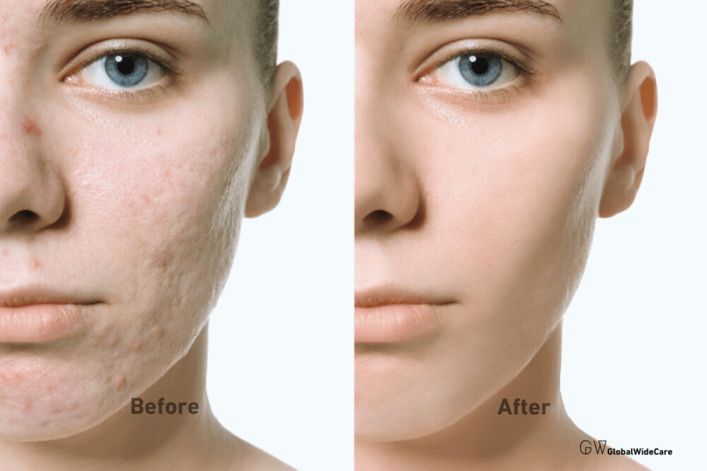 Before and After Acne