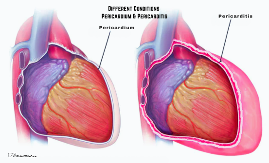 Pericardium and Pericarditis