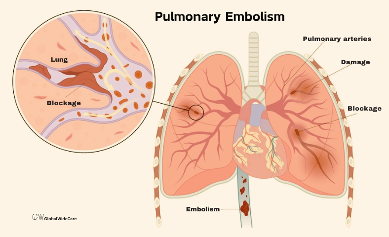 • Pulmonary Embolism