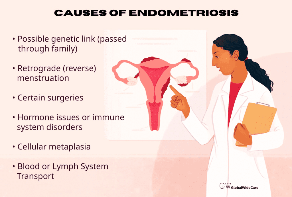 Causes of Endometriosis