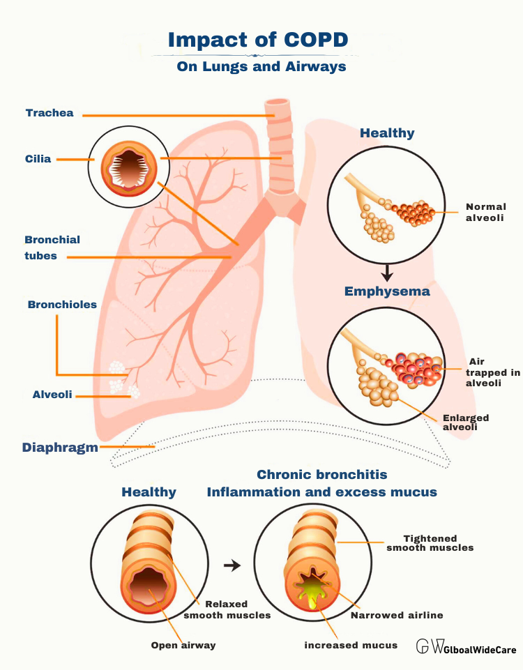 Impact of COPD