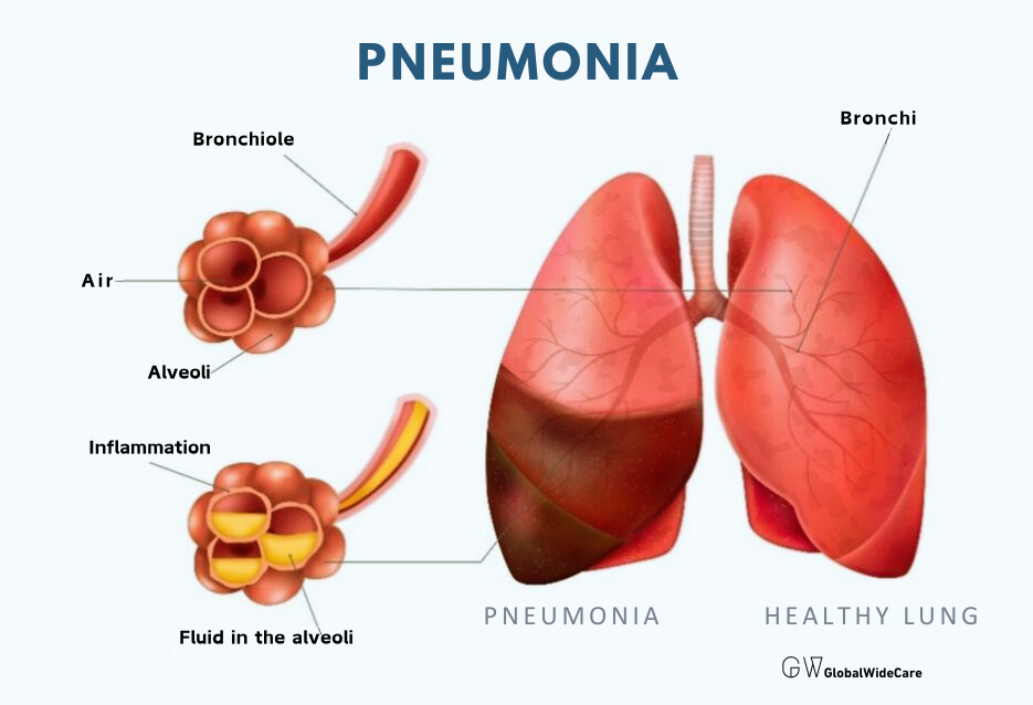 • Pneumonia