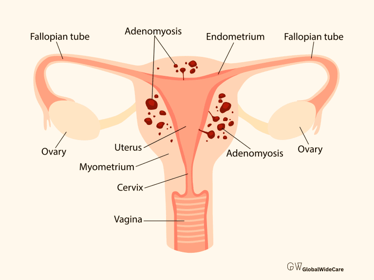 Endometriosis